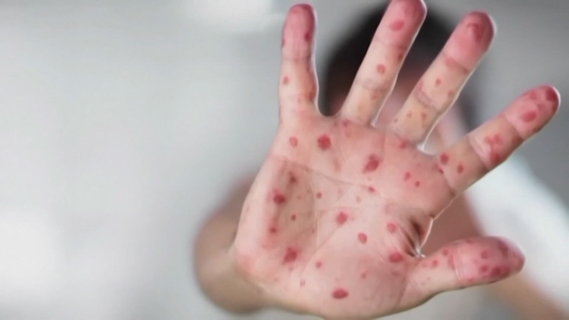 Health Officials Warn of Measles Risk as Spring Break Travel Begins