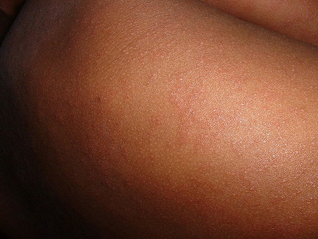 Two Measles Cases Confirmed In Hillsdale County